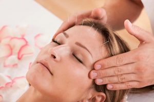 Woman receiving cosmetic acupuncture treatment on her face for headache and migraine relief