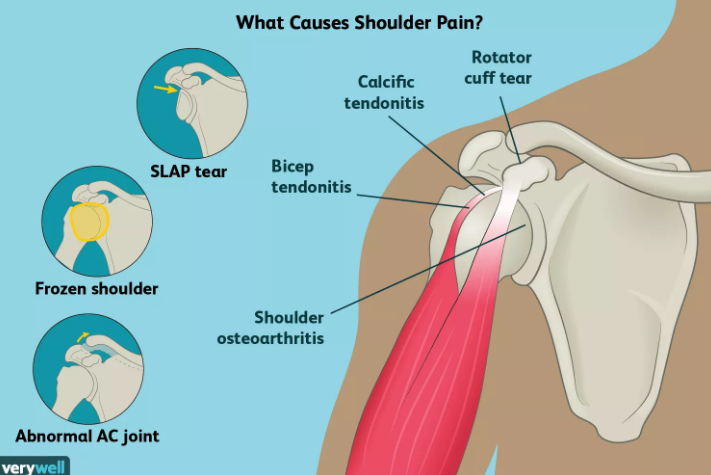  cause of shoulder pain