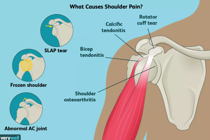 Shoulder Pain Causing You Problems? - Happipuncture