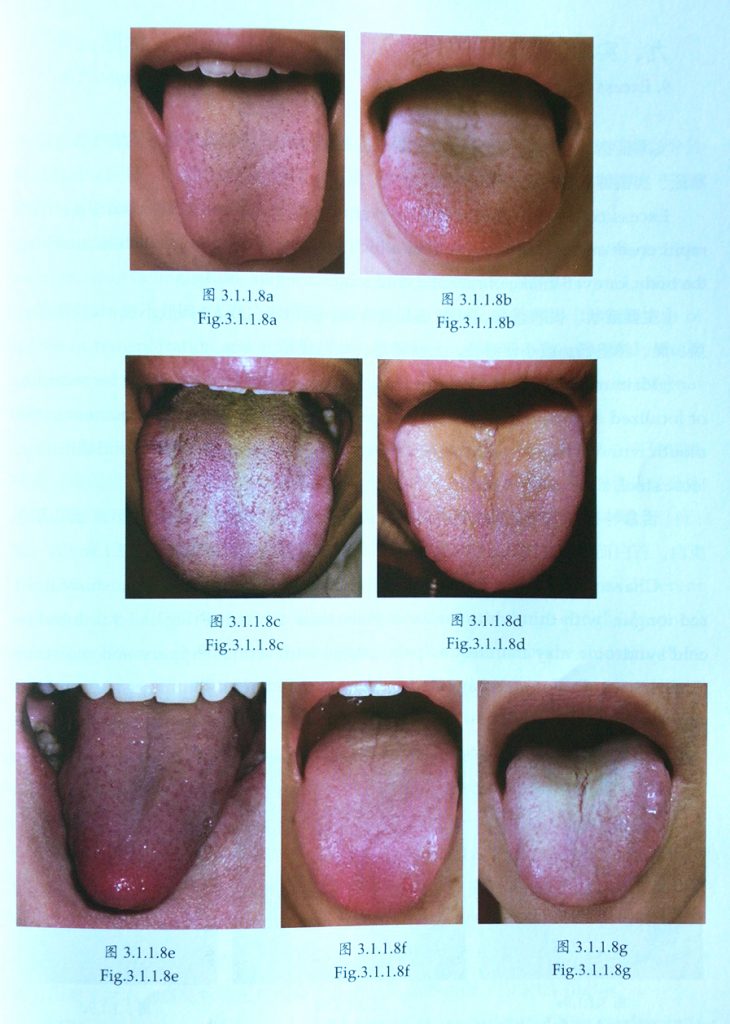 tongue diagnosis heat