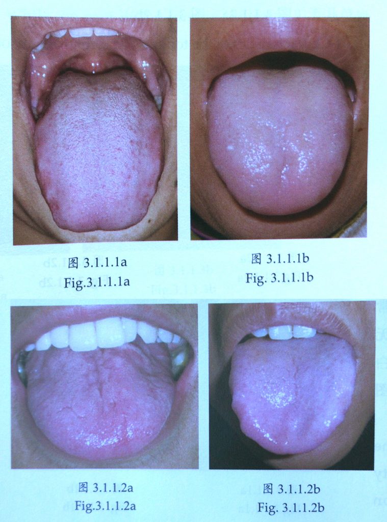 tongue diagnosis qi and blood deficiency