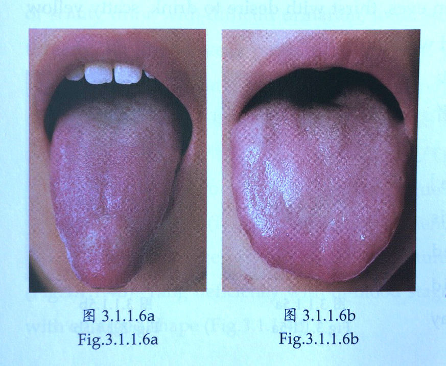 tongue diagnosis qi stagnation