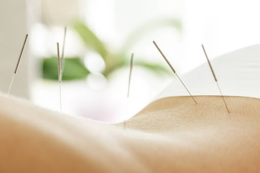 Acupuncture treatment with several needles inserted into the lower back of a patient