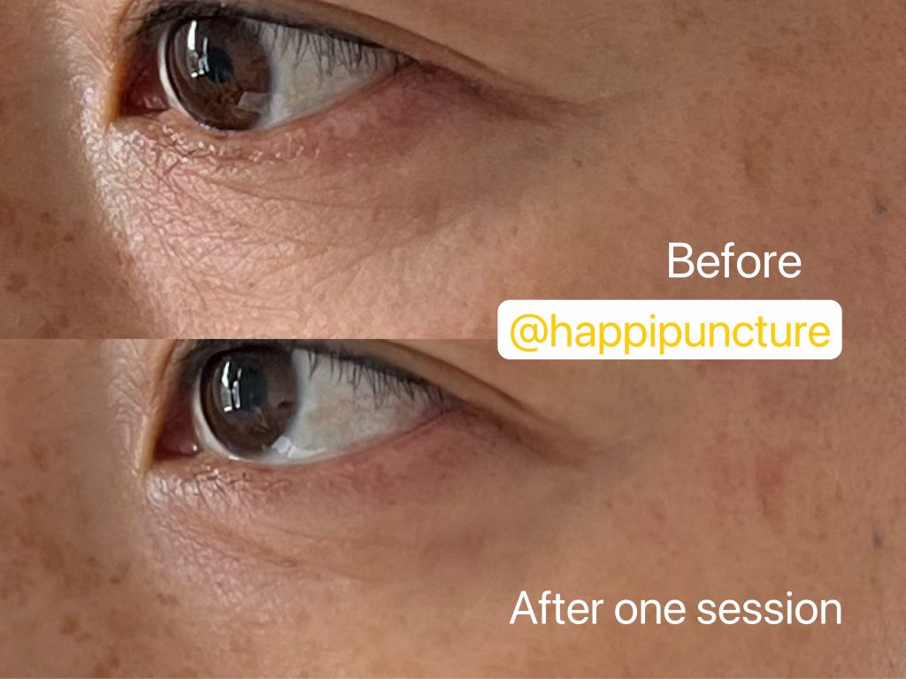 cosmeticacupuncturefacialsculpting