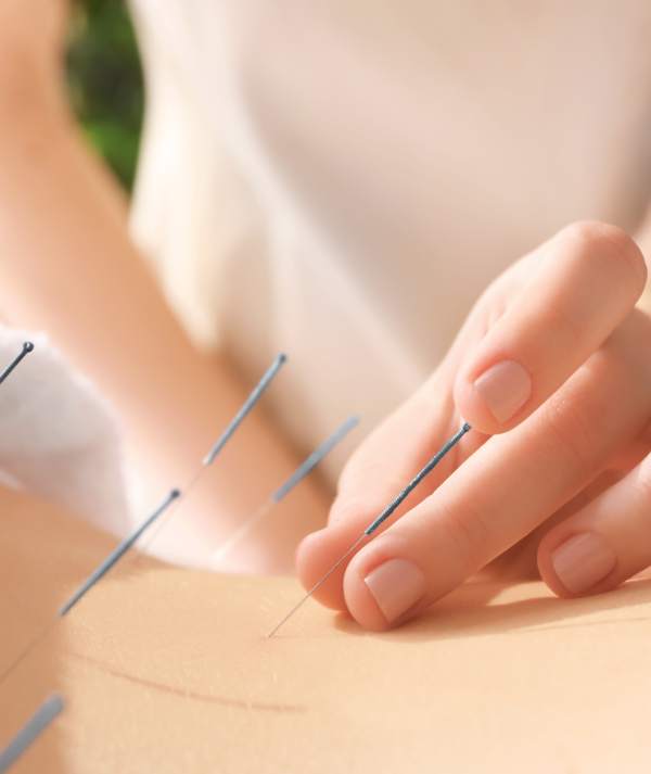 Close-up of an acupuncture needle being applied to the upper back of a woman receiving a holistic acupuncture treatment by a professional acupuncturist.