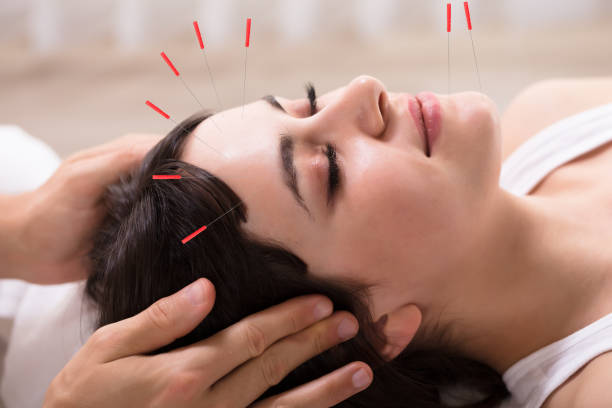 Woman receiving cosmetic acupuncture treatment in a reclined position