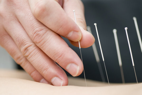Acupuncturist administering treatment on a person's back with needles in place