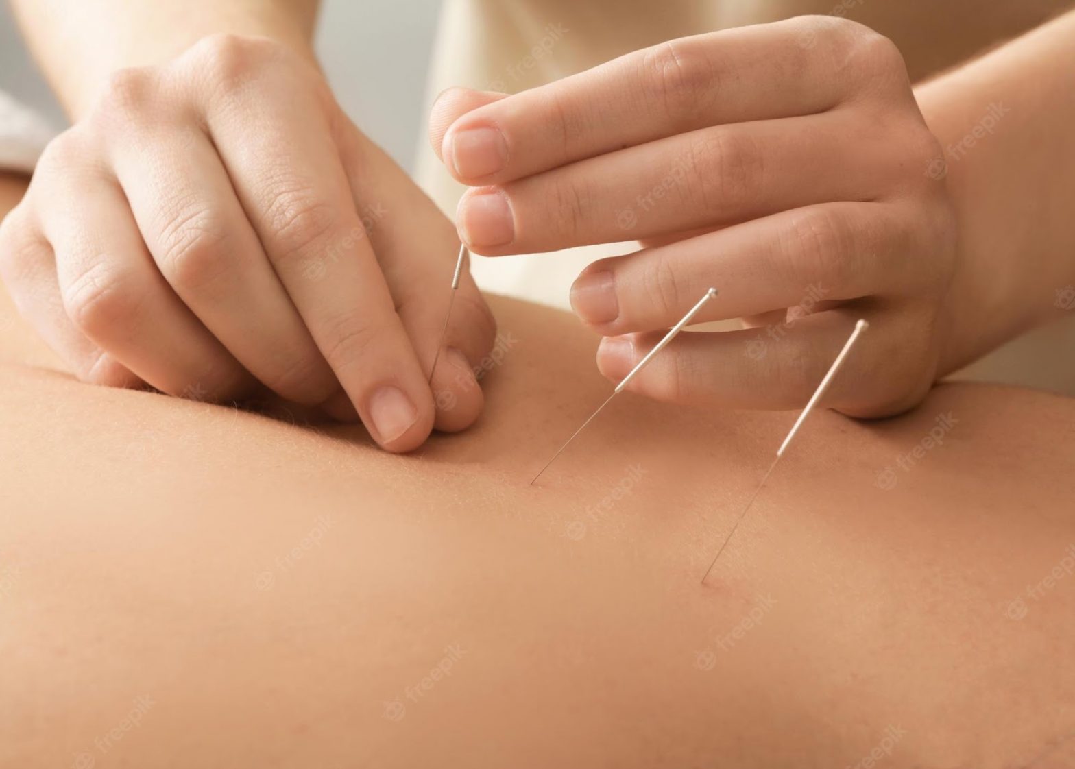 Acupuncturist treating a patient's back with a needle in hand.