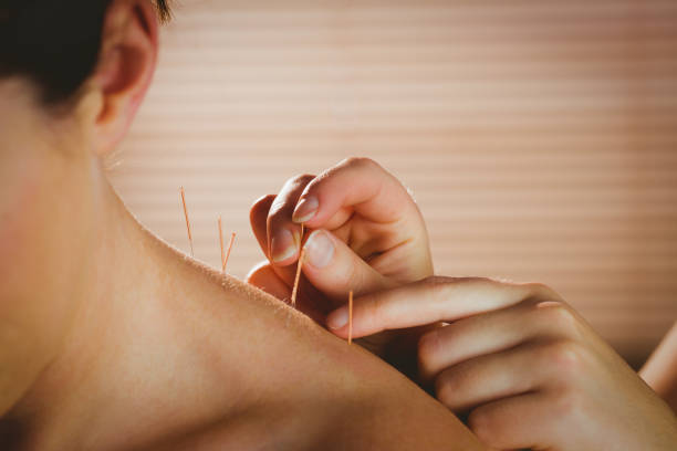 Close-up of an acupuncture needle being applied to the lower neck of a young woman receiving acupuncture treatment in a therapy room by a skilled acupuncturist.