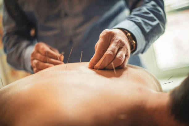 Close-up view of a man receiving Chinese acupuncture treatment, lying face down while the acupuncturist applies a needle to his back.