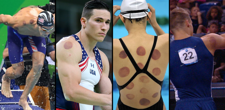 Cupping Therapy Helps Athletes